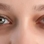 Göz Altı Morlukları için Etkili ve Doğal Çözümler