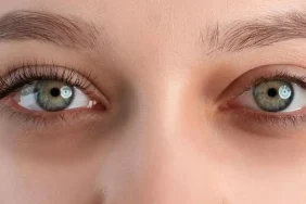 Göz Altı Morlukları için Etkili ve Doğal Çözümler