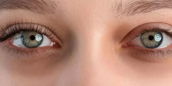 Göz Altı Morlukları için Etkili ve Doğal Çözümler