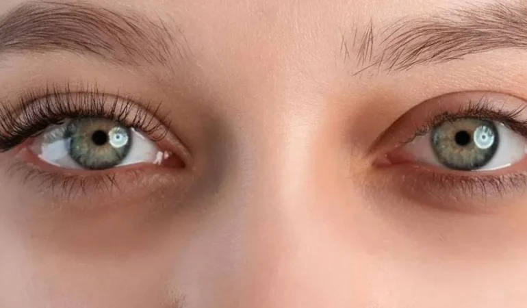 Göz Altı Morlukları için Etkili ve Doğal Çözümler