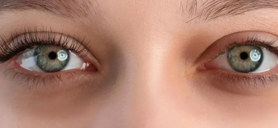 Göz Altı Morlukları için Etkili ve Doğal Çözümler